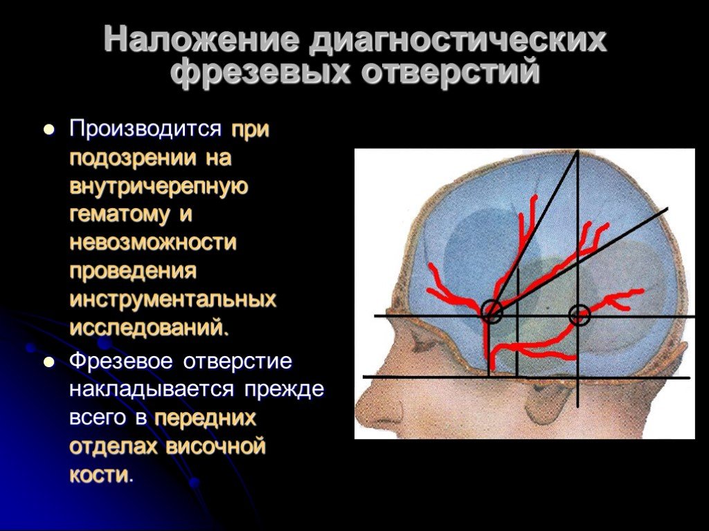 Схема черепно мозговой топографии схема кренлейна