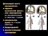 Дислокация мозга проявляется: парезом конечностей (моно-, или гемипарезом) на противоположной от гематомы стороне; расширением зрачка на стороне гематомы; брадикардией; эпилептическими припадками.