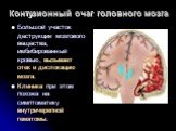 Контузионный очаг головного мозга. Большой участок деструкции мозгового вещества, имбибированный кровью, вызывает отек и дислокацию мозга. Клиника при этом похожа на симптоматику внутричерепной гематомы.