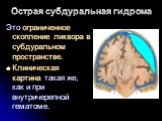 Острая субдуральная гидрома. Это ограниченное скопление ликвора в субдуральном пространстве. Клиническая картина такая же, как и при внутричерепной гематоме.