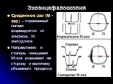 Эхоэнцефалоскопия. Срединное эхо (М - эхо) – отраженный сигнал формируется от эпифиза, III желудочка Направление и степень смещения М-эха указывает на сторону и величину объемного процесса