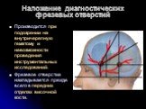 Наложение диагностических фрезевых отверстий. Производится при подозрении на внутричерепную гематому и невозможности проведения инструментальных исследований. Фрезевое отверстие накладывается прежде всего в передних отделах височной кости.