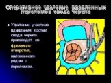 Оперативное удаление вдавленных переломов свода черепа. Удаление участков вдавления костей свода черепа производят из фрезевого отверстия, наложенного рядом с переломом.