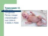 Трисомия 13. Частота синдрома Патау среди новорождён-ных равна 1:5000-1:7000
