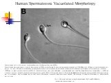 Human Spermatozoa Vacuolated Morphology. Spermatozoa with large nuclear vacuoles observed at high magnification (≥8400×). Spermatozoa were analyzed at greater than or equal to 8400x magnification by inverted microscope equipped with DIC/Nomarski differential interference contrast optics. At least 20