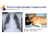 Микоплазменная пневмония. Mycoplasma pneumoniae Infections Red Book.; 2006: 468-470.