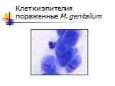 Клетки эпителия пораженные M. genitalium