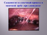 Сальпингит и спаечный процесс в маточной трубе при хламидиозе