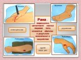 Рана – повреждение целостности кожных покровов тела, слизистых оболочек в результате механического воздействия. укушенная огнестрельная другие виды ран