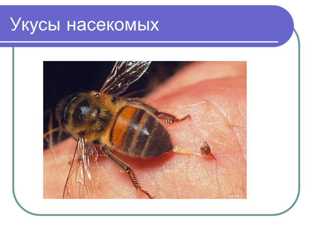 Тема укусы насекомых. Укусы насекомых первая помощь. Презентация на тему укусы насекомых.