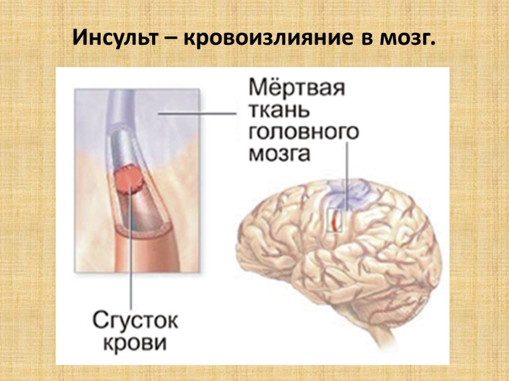 Может быть инсульт мозгов. Кровоизлияние в мозг это инсульт. Гибель головного мозга.