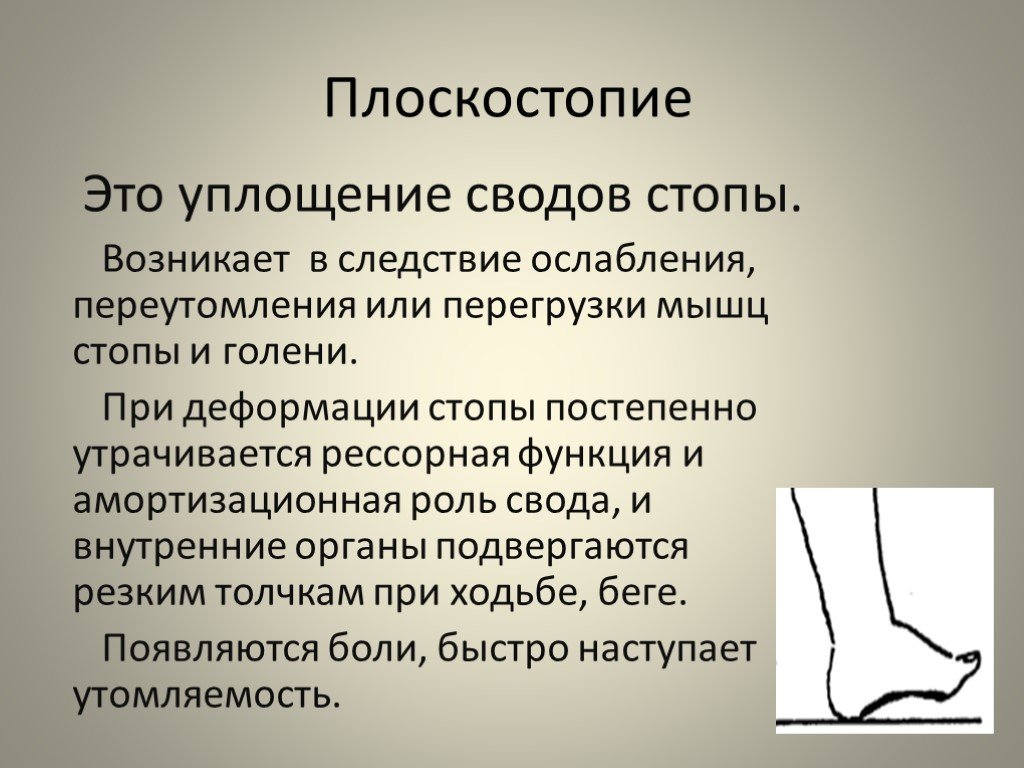 Плоскостопие. Уплощение сводов стопы. Плоскостопие это уплощение сводов стопы. Уплощение продольного свода стопы.