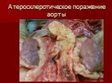 Атеросклеротическое поражение аорты