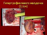 Гипертрофия левого желудочка (2,1см)