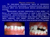 Местная гипоплазия. Это нарушение образования эмали на постоянных зубах в результате вовлечения в воспалительный процесс зачатков зубов или механической травмы развивающегося зачатка. Проявляется местная гипоплазия в виде пятен - от белых до желтовато-коричневых, а чаще в виде точечных углублений, р