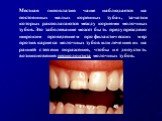 Местная гипоплазия чаще наблюдается на постоянных малых коренных зубах, зачатки которых располагаются между корнями молочных зубов.	Это заболевание может быть предупреждено широким проведением профилактических мер против кариеса молочных зубов или лечения их на ранней степени поражения, чтобы не доп