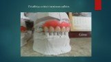 Подбор и постановка зубов
