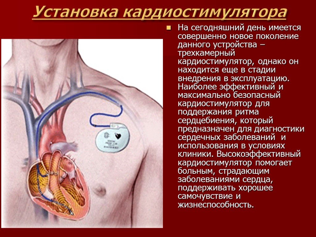 При наличии кардиостимулятора можно. Кардиостимулятор сердца. Установленный кардиостимулятор. Кардиостимулятор операция. Трехкамерный кардиостимулятор сердца.