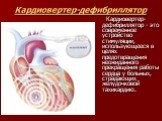 Кардиовертер-дефибриллятор. Кардиовертер-дефибриллятор - это современное устройство стимуляции, использующееся в целях предотвращения неожиданного прекращения работы сердца у больных, страдающих желудочковой тахикардию.