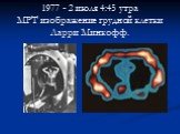 1977 - 2 июля 4:45 утра МРТ изображение грудной клетки Ларри Минкофф.
