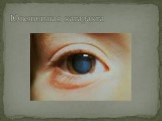 Ювенильная катаракта