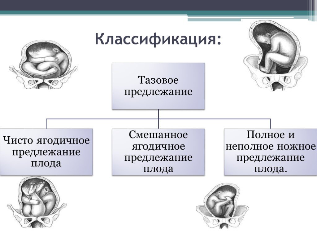 Тазовое предлежание презентация