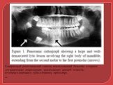 Панорамный рентгеновский снимок, показывающий большим и хорошо ,отграниченное повреждение, вовлекающее нижней челюсти, от второго коренного зуба к первому премоляру. ___