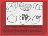 . Варианты рентгенологических картин амелобластом (по А.Л. Козыревой, 1959 г) 1 - ряд округлых полостей; 2 - одна полость, окруженная более мелкими полостями; 3 - округлые полости, содержащие зуб; 4 - многоугольные полости; 5 - мелкие кисты, образующие петлистость кости; 6 - единичные крупные кистоз