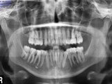 Шинирование зубов при заболеваниях пародонта Слайд: 4