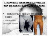 Симптомы, характерные только для врожденного вывиха бедра: · асимметрия кожных складок на бедре. наружная ротация ножки.
