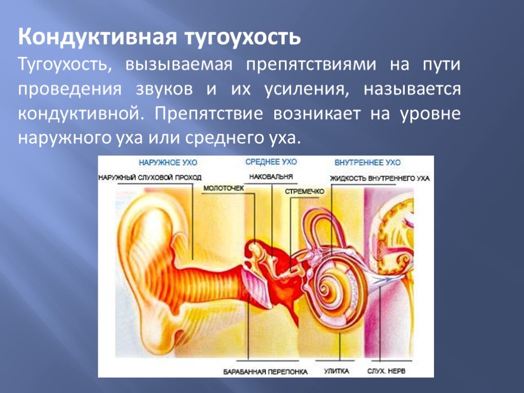 Болезнь внутреннего уха. Несиндромальная нейросенсорная тугоухость. Механизм развития нейросенсорной тугоухости:. Кондуктивная и сенсоневральная тугоухость. Сенсоневральная тугоухость 4 степени.
