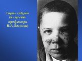 Lupus vulgaris (из архива профессора В.А.Леонова)