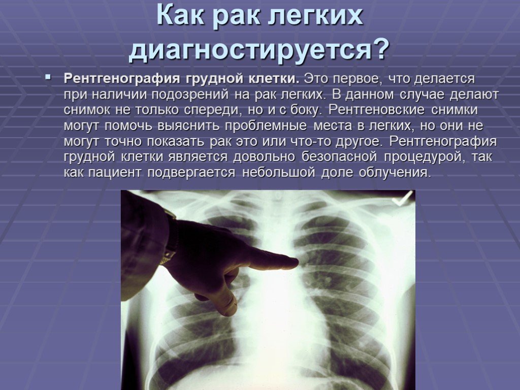 Рак легких отзывы пациентов. Рентгенография лёгких. Рентгенография грудной клетки.