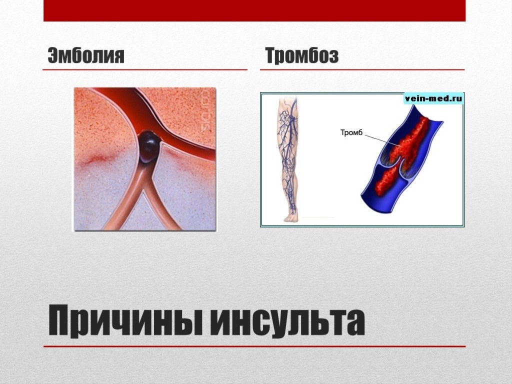 Тромб после инсульта. Причины тромбозов и эмболий. Причины артериальной эмболии.