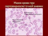 Мазок крови при серповидноклеточной анемии