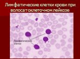 Лимфатические клетки крови при волосатоклеточном лейкозе