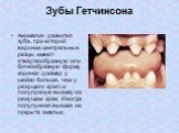 Зубы Гетчинсона. Аномалия развития зуба, при которой верхние центральные резцы имеют отвёрткообразную или бочкообразную форму коронки (размер у шейки больше, чем у режущего края) и полулунную выемку на режущем крае. Иногда полулунная выемка не покрыта эмалью.