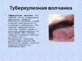 Туберкулезная волчанка. Туберкулезная волчанка. Это наиболее частое туберкулезное заболевание слизистой оболочки рта возникает у людей с хорошей реактивностью по отношению к возбудителю. Оно поражает преимущественно кожу лица. Нередко процесс с кожи носа распространяется на кожу верхней губы, красну