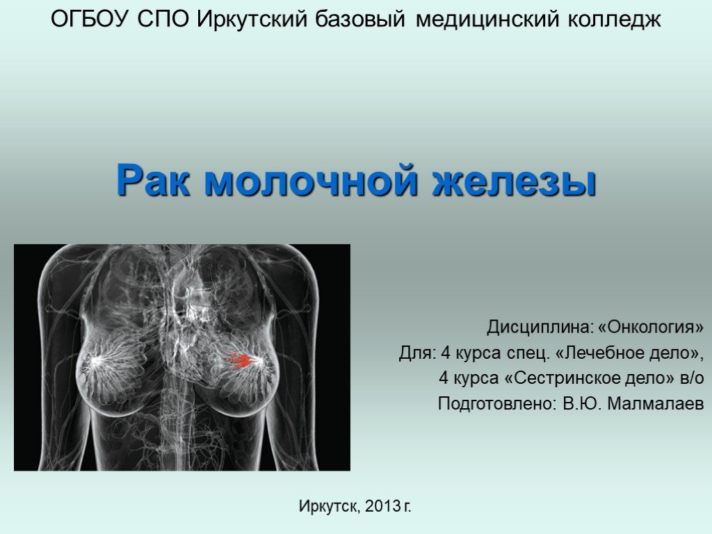 Не заметили рак. Онкология грудной железы. Опухоли молочной железы презентация. Онкология молочной железы презентация.