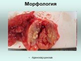 Морфология Аденокарцинома