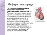Инфаркт миокрада. – это некроз мышцы сердца в результате нарушения кровоснабжения данной области Причина – атеросклеротическое поражение коронарных артерий. В пораженных участках артерий, потерявших эластичность, в результате пульсации может возникнуть микротрещина на внутренней оболочке. На этом ме