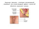 Анальная трещина - спонтанно возникающий линейный или эллипсовидный дефект слизистой оболочки анального канала.