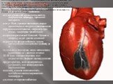Инфаркт миокарда. Гибель участка сердечной мышцы из-за недостаточного снабжения его артериальной кровью называется инфарктом миокарда, причиной которого могут быть сужение питающих сердце кровеносных сосудов, вдавливание их окружающими тканями, например, при отеке, закупорка тромбом или атеросклерот