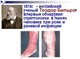 1874г. – английский ученый Теодор Бильрот впервые обнаружил стрептококки в тканях человека при роже и раневой инфекции