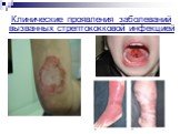 Клинические проявления заболеваний вызванных стрептококковой инфекцией
