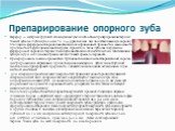 Препарирование опорного зуба. Фарфор — материал хрупкий, это вынуждает увеличить объем препарирования твердых тканей зуба на глубину до 2,0 мм, т. е. в 4—5 раз больше, чем под штампованную коронку. Утолщение фарфоровой коронки необходимо для придания ей прочности и возможности противостоять функцион