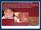 Токсическая эритема является своеобразной аллергической реакцией кожи новорожденного. Проявляется в виде гиперемированных пятен, папул, везикул на всей коже, кроме ладони и стоп. По мере угасания переходит в шелушение.
