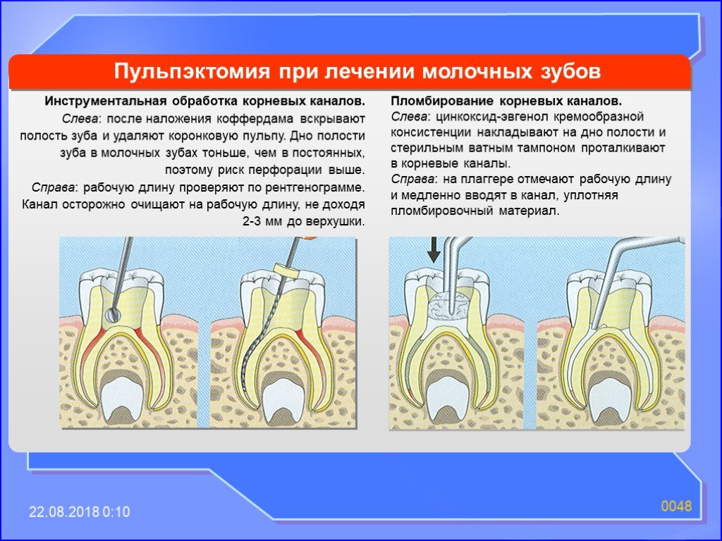 Временное пломбирование корневых. Количество корневых каналов в молочных зубах. Корневые каналы молочных зубов. Материал для пломбирования каналов зуба.