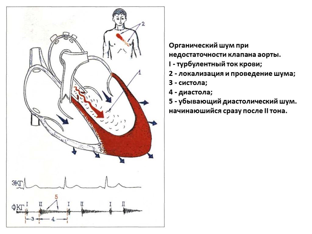 Аортальная сердечная недостаточность. Аускультация при аортальной недостаточности. Недостаточность аортального клапана аускультация. Шум при недостаточности аортального клапана. Органический шум при недостаточности клапанов аорты.