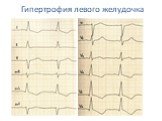 Гипертрофия левого желудочка